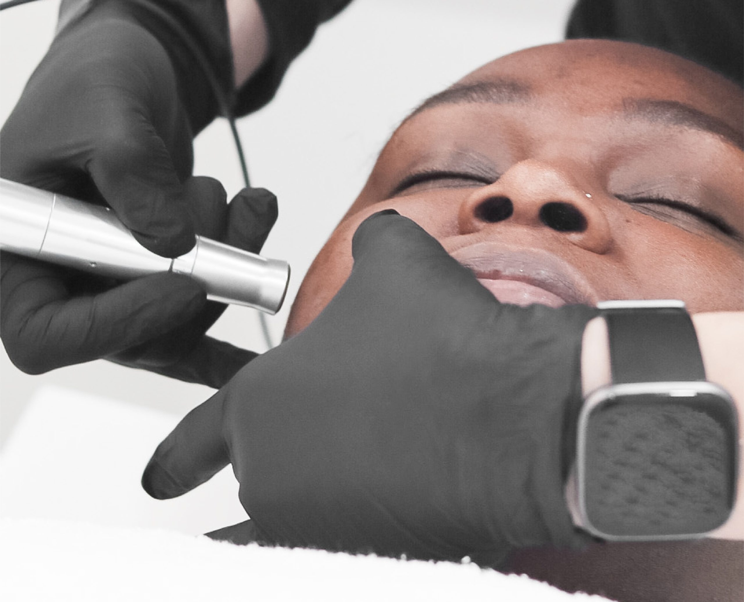 An esthetician performing microneedling. Learn advanced skincare techniques with our microneedling course in Winnipeg, designed for estheticians looking to elevate their skills.