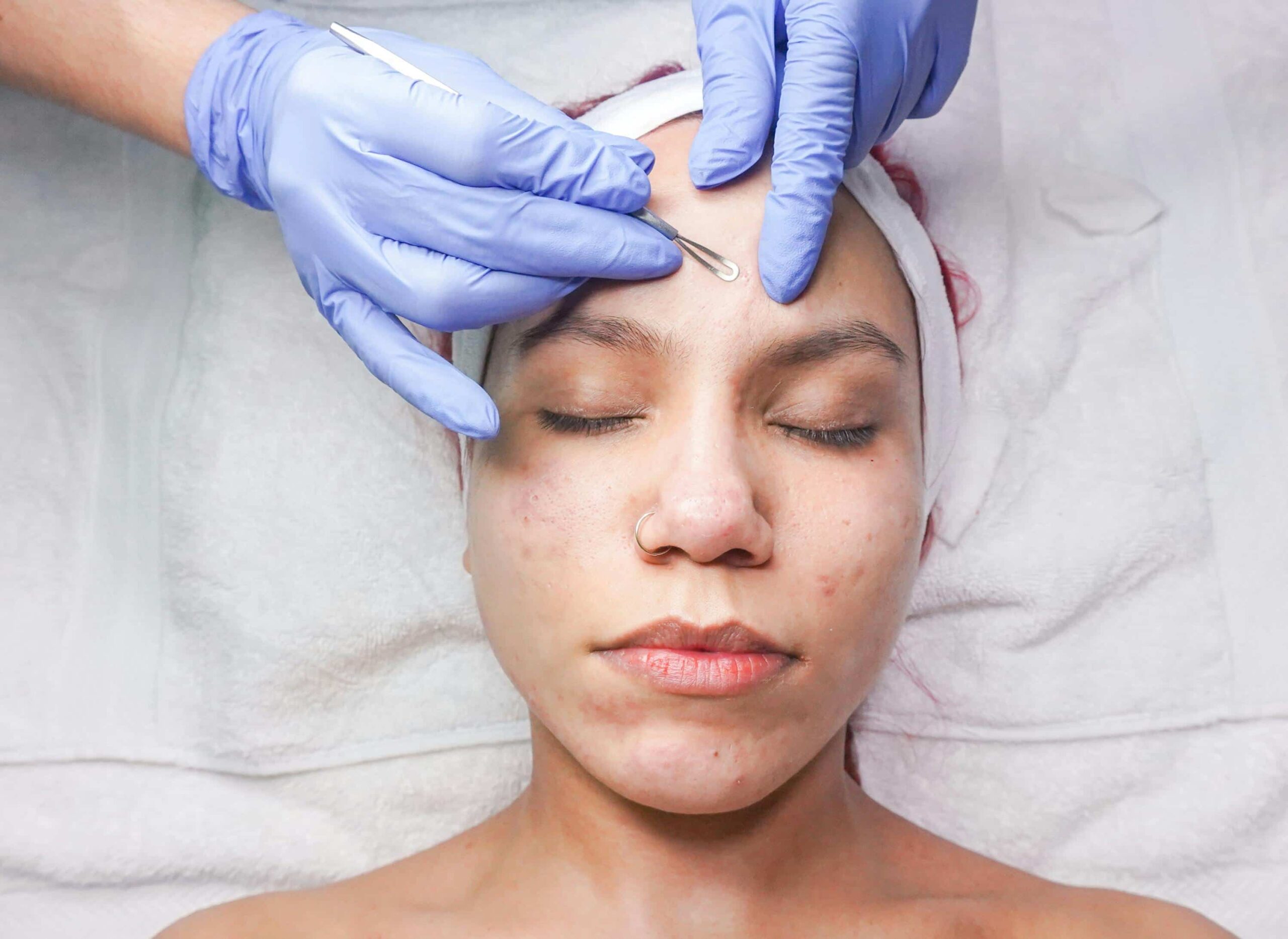 	Person receiving a professional acne facial at one of the top Esthetician Schools in Winnipeg
