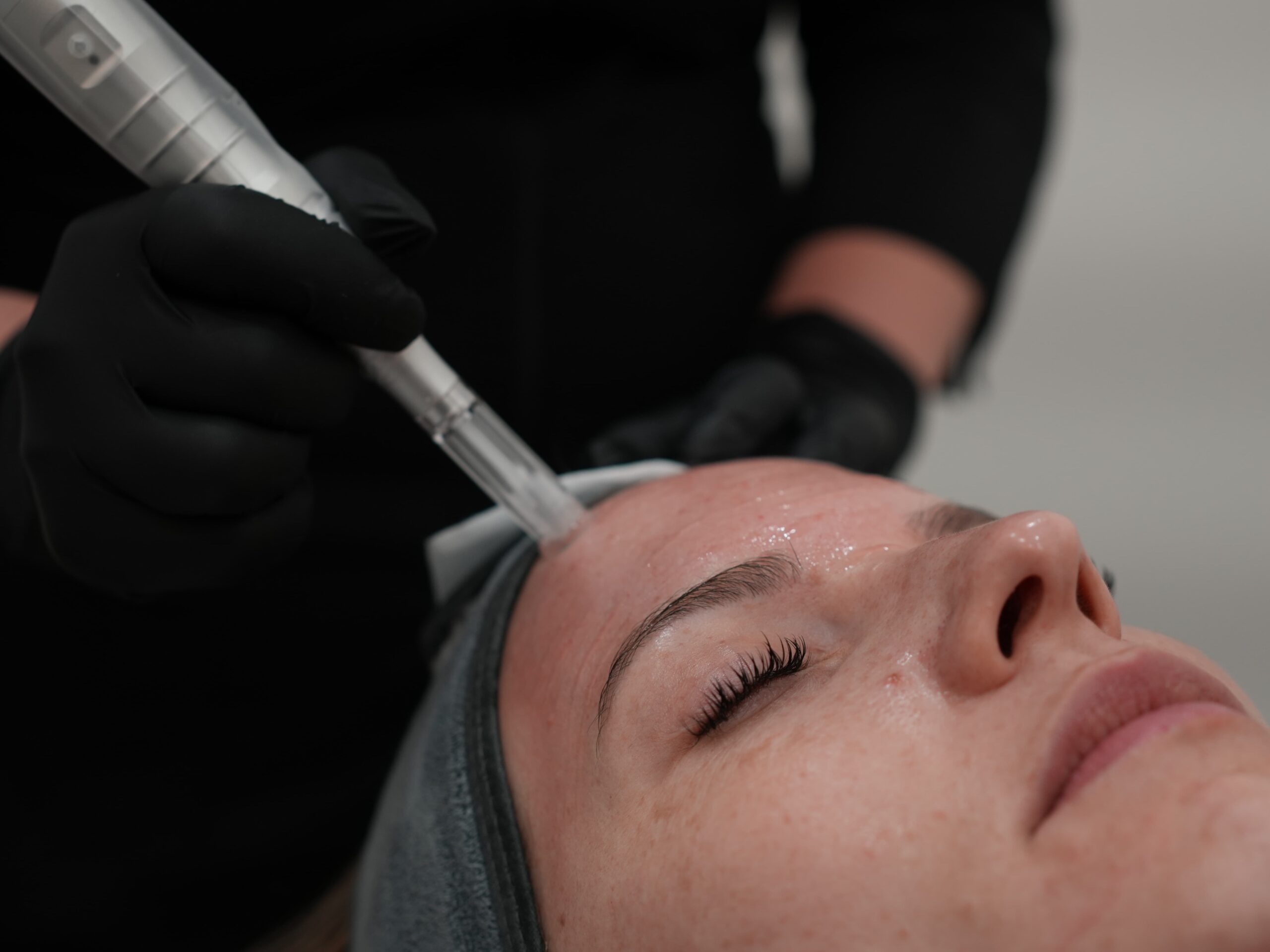 Microneedling course winnipeg Model receiving a microneedling service in Winnipeg (Model receiving a microneedling service in Winnipeg)